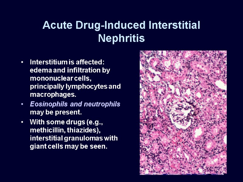 Acute Drug-Induced Interstitial Nephritis Interstitium is affected: edema and infiltration by mononuclear cells, principally